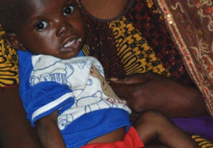 Enfant vulnérable confronté à la malnutrition au Mali